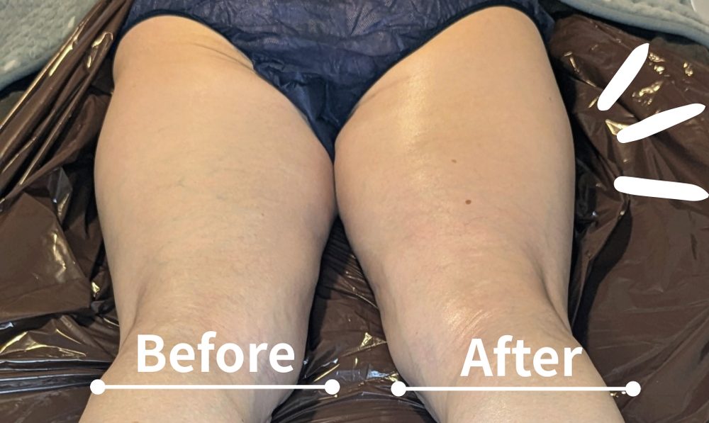 太もものビフォーアフター